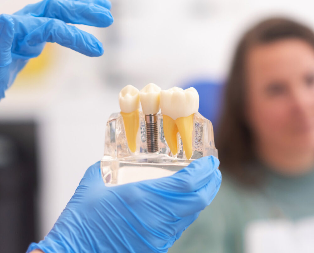 jak uzupełnić brak tylnych zębów za pomocą implantów